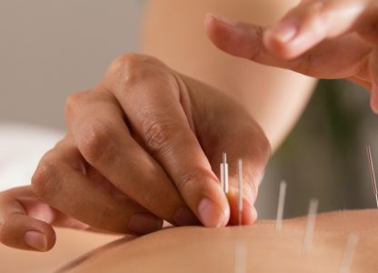 Acupuncture
